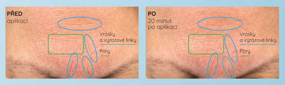 yellow-rose-hyaluronic-filler-pred-po